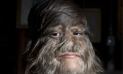 真是小毛孩！全世界最毛茸茸的女孩 世界紀錄、多毛症、狼人綜合症、狼人、金氏