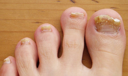 灰指甲不是秋冬流行的顏色！ 灰指甲系列噁圖 灰指甲、噁心、發霉、黴菌