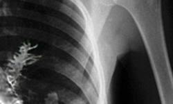 肺裡長出樹？獵奇版落地生根    松樹、肺、奇聞、Artyom Sidorkin、腫瘤、X光