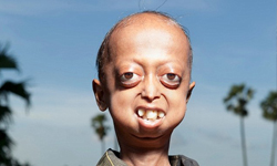 真人版班傑明！印度男童14歲擁有110歲身體    印度、男童、14歲、  真人版、班傑明