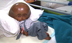 大頭娃娃真人版 腦積水印度女童成功脫離險境 印度、Roona Begum、腦積水、水腦