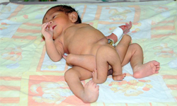 6腿寶寶截肢手術前後對照圖 寄生、雙胞胎、連體嬰 、寶寶、嬰兒