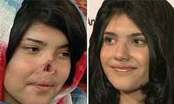 毀容後重獲新面孔　那些植鼻人的故事 植鼻、鼻子、手術、對照、照片