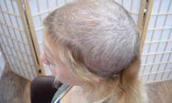 頭髮真的有被拔光的一天 妙齡女孩變禿頭實錄 拔毛症、Trichotillomania、Natalie Blyth、India Barne、強迫症