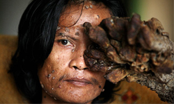 半人半樹非所願　樹人的悲傷故事 樹人、樹人病、樹幹、疾病、醫療