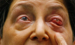 牙齒植入眼中　盲人恢復視力 骨齒、牙齒、人工、角膜、盲人