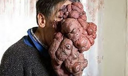 血管瘤佈滿整臉　無臉男José Mestre奇異的人生歷程 血管瘤、臉、無臉男、葡萄牙、男子