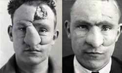 首位抽脂女模命喪黃泉！整形史上的各類型案件大紀元 整形、大紀元、Walter Yeo、Harold Gillies、Michael Dillon