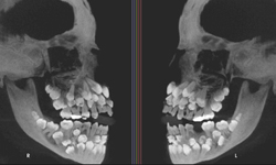 掉再多牙都不怕？雞皮疙瘩掉滿地的多齒症Hyperdontia 牙齒、多齒症、Hyperdontia、獵奇