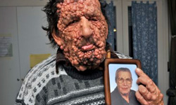 神經性纖維瘤長滿臉　被教宗親吻的男人 神經性纖維瘤、neorofibromatosis、Vinivio Riva、教宗、Francis