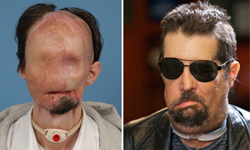 臉上只剩一張嘴　美國逆子Dallas Wiens劇變人生的感動故事 美國、父親、爸爸、德州、波士頓