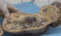 82歲老嫗腹中取出40年石胎！胎兒死於腹中完全鈣化 82、老嫗、腹中、取出、40年