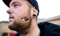 玻璃瓶砸臉刺進肉裡　卡臉頰17天血流不止 玻璃瓶、玻璃、刺、砸、臉、肉、臉頰、血流不止、流血、血腥、恐怖、噁心、芬蘭、瑞典、Patrik Moberg