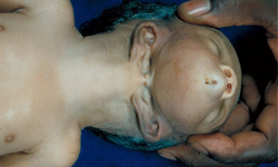 合成圖？真實照？認識胎兒耳頭畸形 畸形、胎兒、寶寶、畸胎、知識