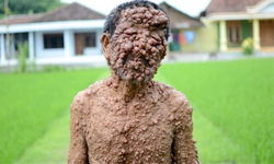肉瘤如雨後春筍般冒出！印尼男子恐失明 腫瘤、雨後春筍、增生、增殖、冒出