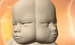 腹中胎兒是兩腦雙面人　父母不顧醫師建議堅持要生 腹中、胎兒、雙面人、父母、醫師
