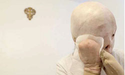 酒駕的恐怖後果：美少女焚燒毀容、十指截肢 酒駕、毀容、車禍、獵奇