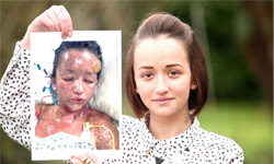 服下處方藥，隨後臉融掉！少女皮膚潰爛脫落、全身如火燒 處方藥、藥、藥物、藥片、融掉