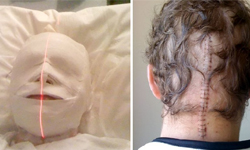 正面木乃伊、背面科學怪人！腦瘤屢次誤診、病患命危震怒 木乃伊、科學怪人、腦瘤、誤診、病患