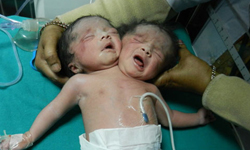 沒錢做產前超音波！女子誕下雙頭嬰大吃一驚 嬰兒、寶寶、小孩、兒童、畸形