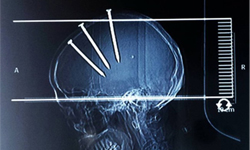 腦袋是裝飾品？3根釘子釘大腦…男健康出院 外科、醫療、醫學、釘子、長釘、男子、大腦、頭腦、裝飾、中國、福建、海豐、恐怖