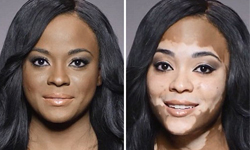 白斑女鏡頭前勇敢卸妝　告訴全世界自然最美 白斑症、白癜風、白蝕症、卸妝、勇敢