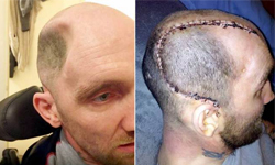 一拳揍到頭顱凹陷！腦損傷致殘疾、肇事者只要關… 頭骨、凹陷、頭顱、頭腦、損傷