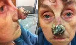 鼻子長瘤大如栗子！醫師誤診婦鼻脫落毀容 癌症、腫瘤、栗子、鼻子、鼻尖