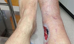 玩滑水道樂極生悲！整塊肉削掉、傷口深見骨 滑水道、樂極生悲、受傷、醫療、醫學