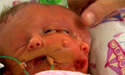 明知畸形、堅持要生！兩腦雙面嬰奇蹟誕生 畸形、雙面、兩腦、兩面、嬰兒
