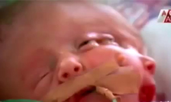 一頭兩臉不同人格　雙面娃出生僅__天即逝世 過世、逝世、死亡、離世、雙面人