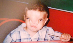 眼距4.5公分、鼻裂如河馬！樂觀顏裂少年建新鼻 眼距、鼻裂、河馬、樂觀、顏裂