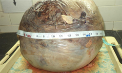 懷的不是寶寶？！大腹便便女血崩、剖出世界最巨瘤 醫學、醫療、恐怖、腹部、腫瘤、巨瘤、世界、最大、最巨、癌症、子宮、子宮肌瘤、15公斤、寶寶、嬰兒、新生兒、詭異、噁心、印度、醫師、醫生、婦科、婦產科、產科   