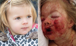 細皮嫩肉變滿臉爛肉！2歲女致命過敏恐失明 女娃、女童、女孩、2歲、過敏、致命、失明、眼睛、黏液、水泡、潰瘍Nurofen、Matt、Sarah、Macey Marsh