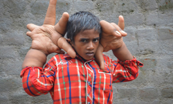 自理生活都成難題　印度男童因瘤而長出巨手 獵奇、巨手、印度、罕見、小男孩、困擾、自卑、腫瘤