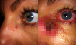 小麥肌、癌症通通都給你　女熱衷日光浴慘皮膚癌上身 懷孕、媽媽、皮膚癌、治療、手術