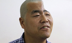 最強的腦補在這裡！半頭人藉3D列印重獲頭殼 頭顱、受創、凹陷、重建、疤痕