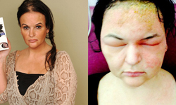 變美不成反變豬頭！女染髮過敏、頭腫如球 染髮、過敏、反應、豬頭、看不見、慘、陰影、D.I.Y、就醫、英國、紅腫