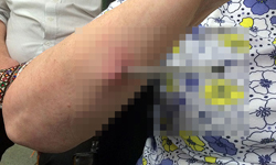 戳戳樂戳到人肉上　嬤遭暴徒用原子筆插穿手臂 攻擊、暴徒、傻眼、長者、阿嬤