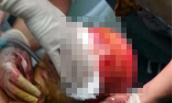 半張臉皮被撕裂　陸女遭碎料機扯落頭皮 恐怖、駭人、頭皮、意外、扯落