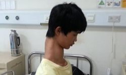 他只不過是想上學…長頸鹿男孩的手術之路 脖子、長頸鹿、頸椎、脊柱側彎、神經、手術、中國、奇人異事、符穩貴