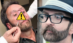 要命還是要臉？男為治病割去半臉、十年後重生 癌症、求生、捨棄、駭人、自卑