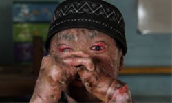 蛇紋身的男孩─16歲少年每41天全身脫皮 印尼、蛇皮症、男孩、脫皮、保命、辛苦、罕見疾病、生病、支持