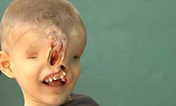 3歲童天生無眼、臉破洞　重建五官獲新生 摩洛哥、男童、無面、五官、疼愛