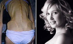 瘦到差點小命不保！10位厭食症女孩的Before & After 厭食症、飲食障礙、女孩、瘦、審美觀、錯誤觀念、健康、營養