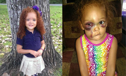 5歲娃上學上到鼻青臉腫！校稱她自己跌倒、母震怒PO網掀公憤 受傷、母親、恐怖、幼稚園、學校