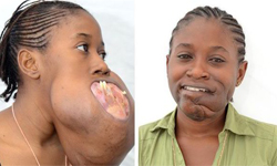 下巴腫瘤比頭大恐窒息　17歲少女摘瘤保命 腫瘤、疾病、醫療、醫學、骨瘤