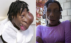 摘1.8公斤面瘤　15歲畸臉少女表示幸福 腫瘤、畸形、面部、少女、女孩