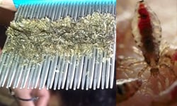 一梳刨起千萬頭蝨！幼女髮間成蝨巢、網友痛批虐童 頭蝨、寄生、恐怖、噁心、影片