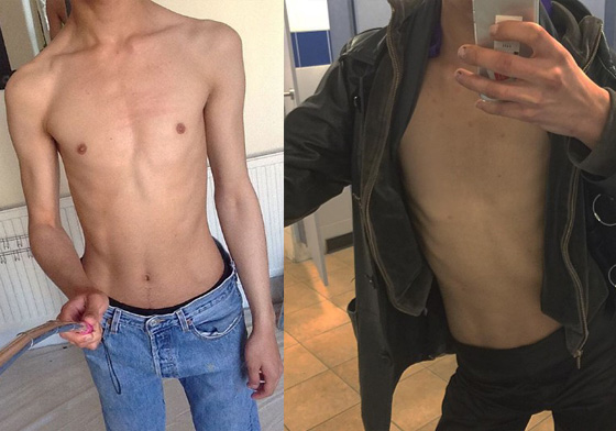 一幅畫讓他決定動手術？少年切除乳頭的原因竟然是… 改造、身體、乳頭、奶頭、器官